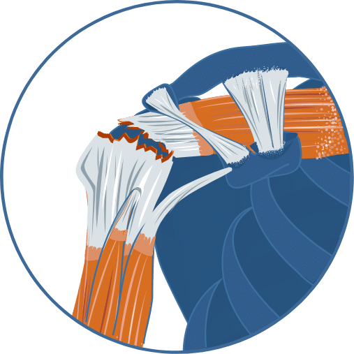 IllustrationRuptureTendonsCoiffeRotateurs