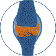 arthrose
